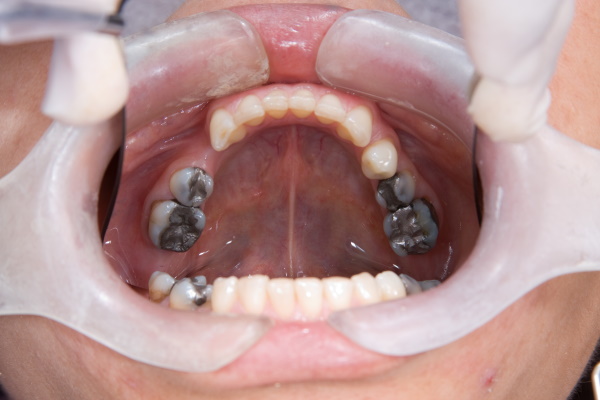 深谷 銀歯を白い歯・セラミックに｜『メタルフリー治療』専門サイト 